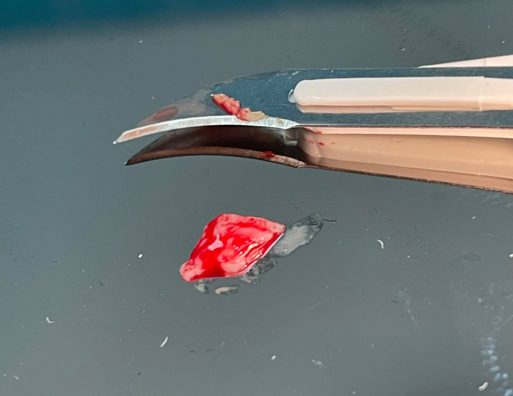 9 полезных фактов об удалении зуба мудрости