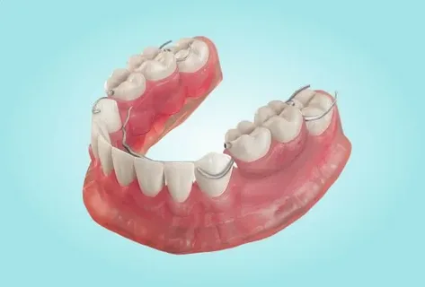 Плюсы и минусы бюгельных протезов