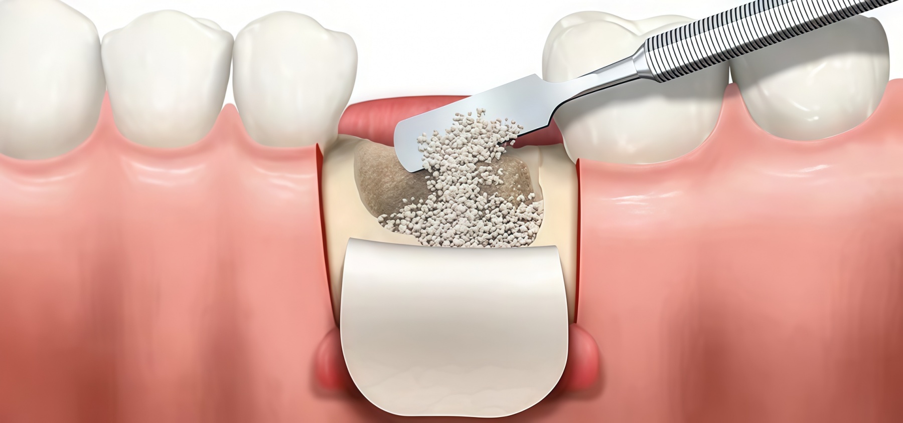 Какой имплант лучше при дефиците костной ткани?