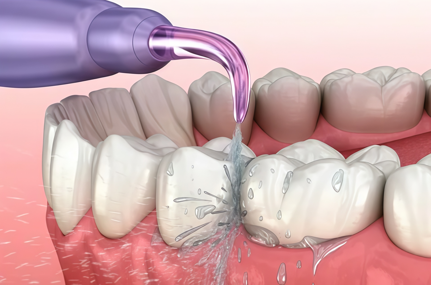 Когда можно использовать ирригатор после имплантации?