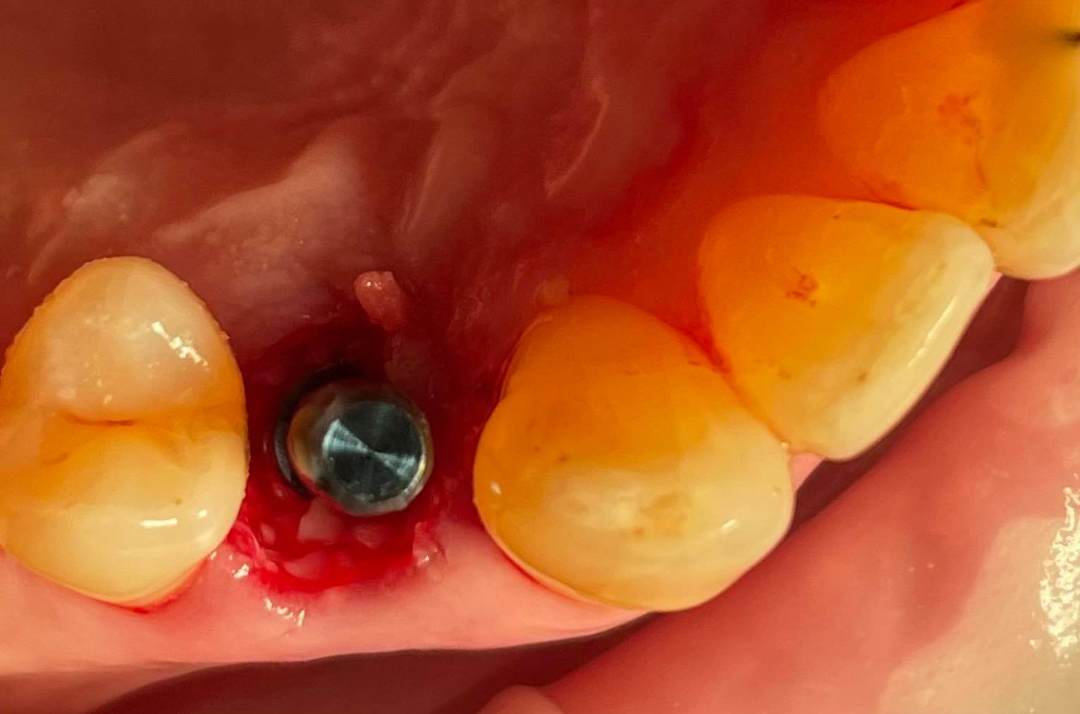 Что будет, если не удалить зуб?