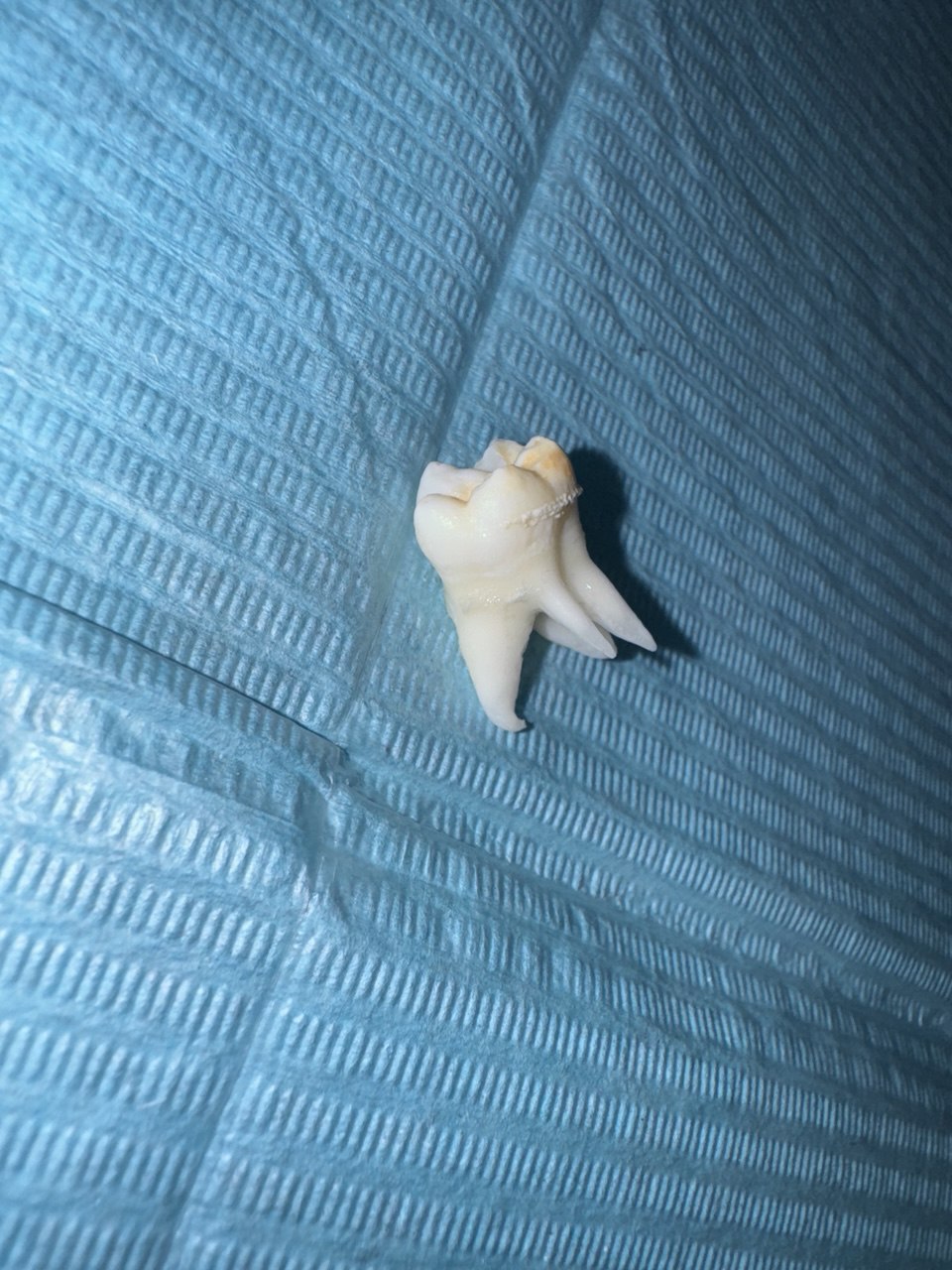 Как удалить зуб мудрости?