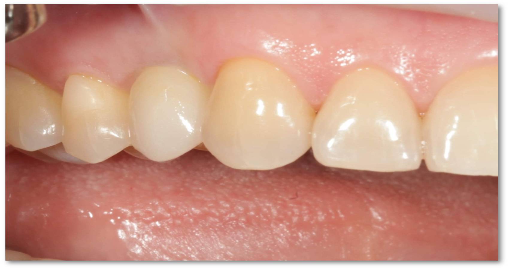 Какие зубы легче всего удалить: верхние или нижние?