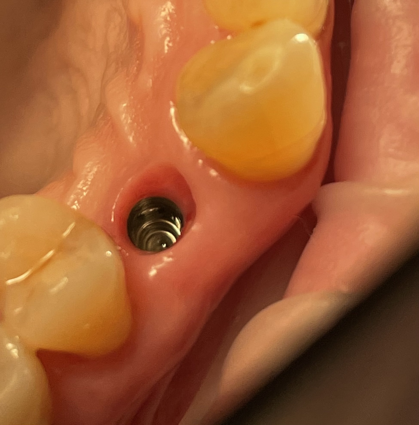 Какие зубы самые болезненные при удалении?