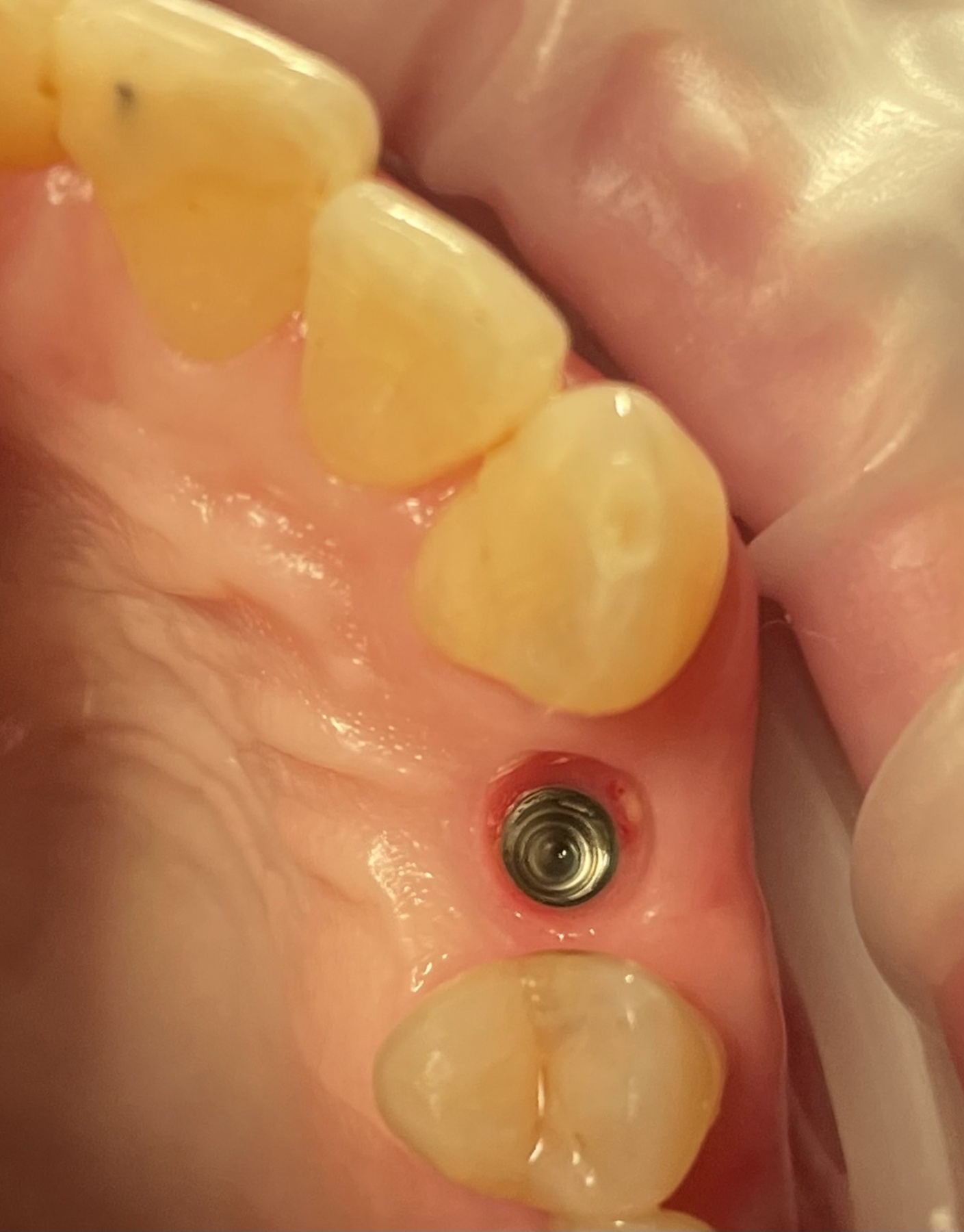 Сколько минут удаляют зуб?