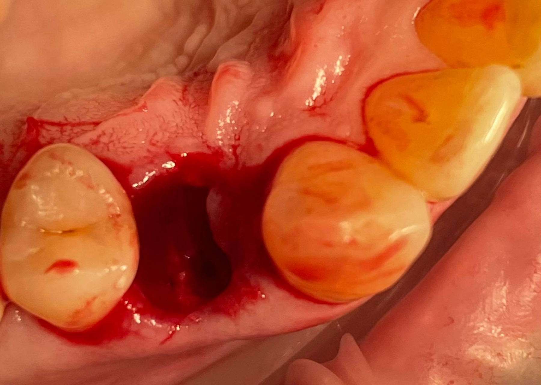 В каких случаях нельзя удалять зуб?